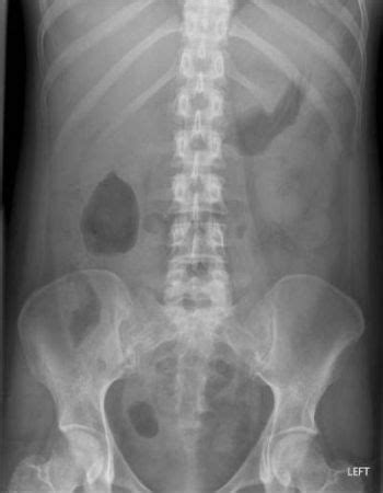 • fluid levels are abnormal when they are seen in dilated bowel loops or. Abdominal_Radiology_Viewing_Approach