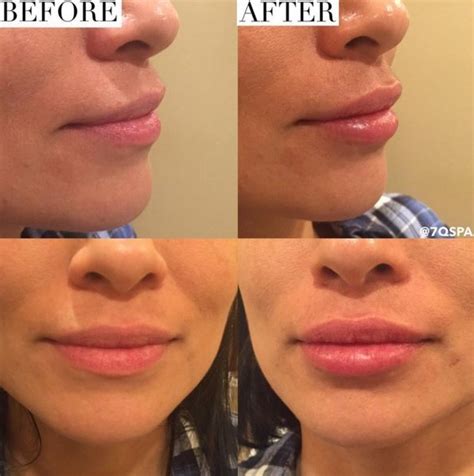 Before After Lip Fillers Using Juvederm Ultra Plus Xc 12 Syringe Was Used To Achieve A Natural