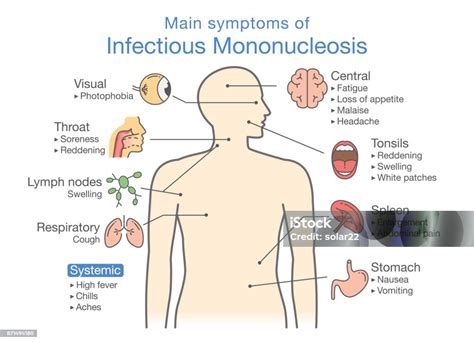 Symptome Der Infektiösen Mononukleose Krankheit Stock Vektor Art Und