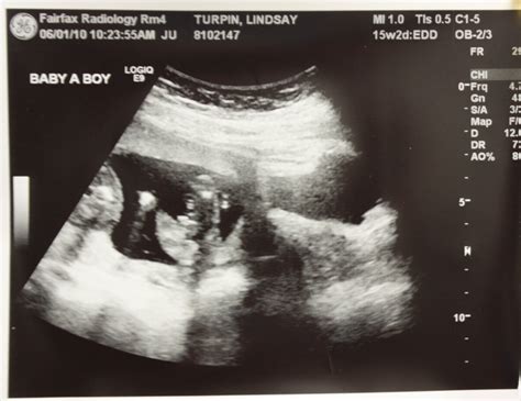 Adventures In Baby Making 16 Weeks Ultrasound Pics