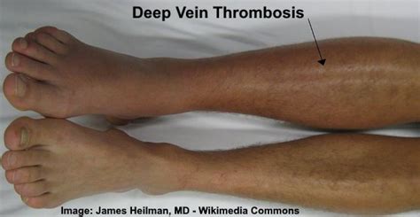 Blood Clot In Leg Symptoms What Does A Blood Clot In The Leg Feel