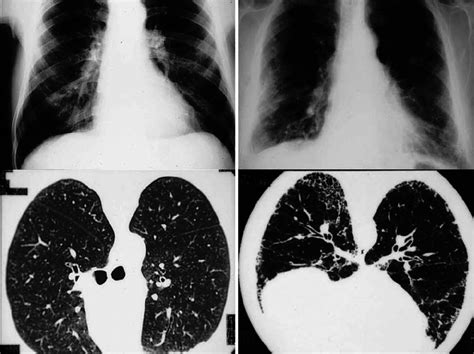 Chest Radiograph And Hrct Of Two Ex Workers From The Asbestos Cement
