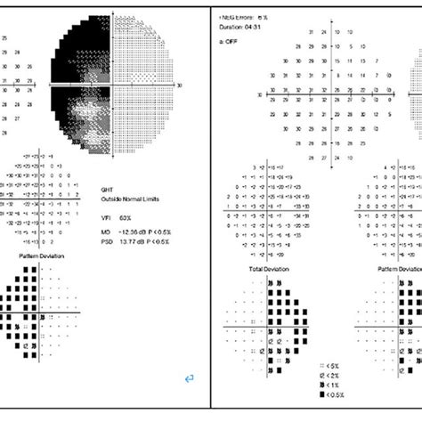 Pre Operative Visual Field Test Download Scientific Diagram