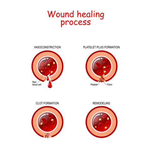 Phases Of The Wound Healing Process Poster With Capillary Red Blood