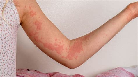 What Do Hives Look Like Symptoms And Treatment