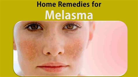 Home Remedies For Melasma Sandalwood And Fresh Lemon Juice Youtube