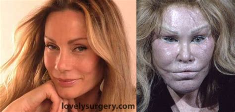 Jocelyn Wildenstein Before And After Plastic Surgery Lovely Surgery