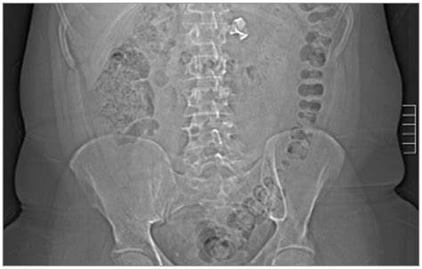 A Patient With Abnormal Abdominal Ct Scan Findings Surgery Jama