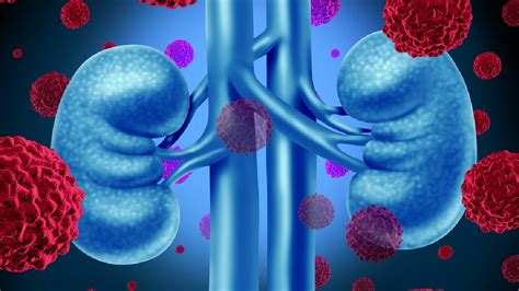 Insuficiencia (renal) de los riñones (colegio americano de radiología. Insuficiencia renal, una enfermedad silenciosa - TVSana