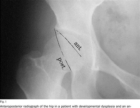 Figure 1 From The Prevalence Of Acetabular Retroversion Among Various