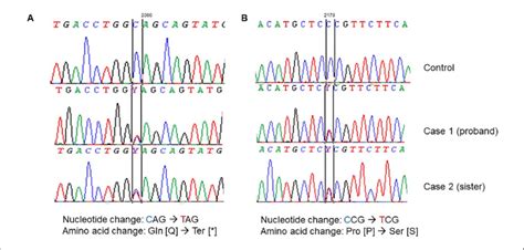 Dna Sequencing Of The Wfs1 Gene Identified Compound Heterozygous Download Scientific Diagram