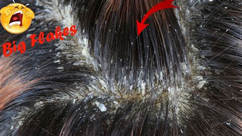 Big Dandruff Worm Hole Scratching Itchy Psoriasis Flakes On Scalp