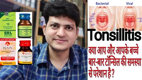 Homeopathic Medicine For Tonsillitis Tonsil Enlarged Tonsil Bio