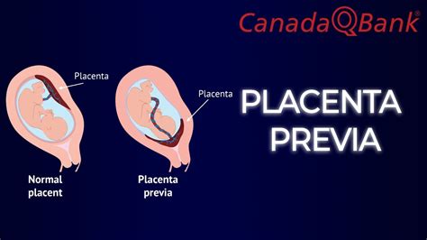 Placenta Previa Youtube