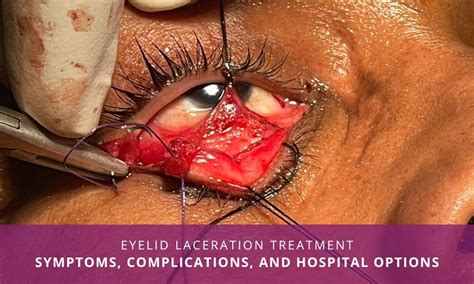 Effective Eyelid Laceration Treatment In India Richardsons Hospital