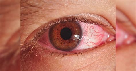 Conjunctivitis Or Akhidhara Disease Is Spreading Rapidly Know Its