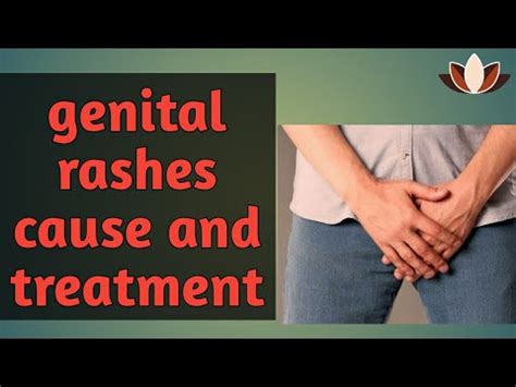 What Are Causes Of Genital Rash Rash On Penis How To Get Rid Of Genital Rashes Youtube