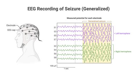 Eeg Recording Of Seizure Generalized Biorender Science Templates