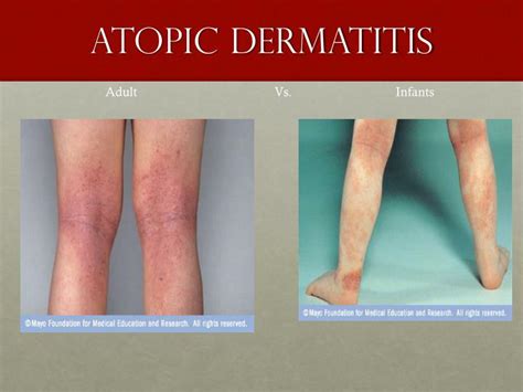 Ppt Atopic Dermatitis Eczema Powerpoint Presentation Id2351905