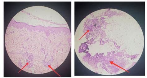 Histopathology Image Of Skin Showing Perivascular Lymphocytic