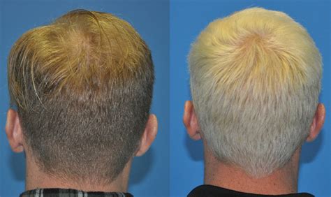 Frontal Forelock 2000 Graft FUE Hair Transplant Case Study Carolina