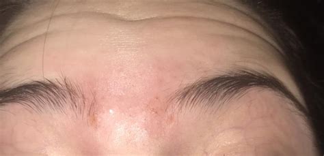 So Many Hard Lumps Between Eyebrows That Have Pus In Them General