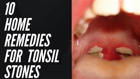 10 Home Remedies For Tonsil Stones That Work Fast How To Get Rid Of