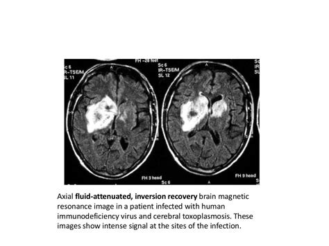 Cns Infections Radiology