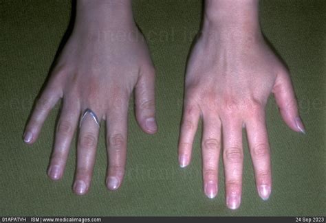 Stock Image Argyria Argyrosis Of The Hand Left Compared With A Normal