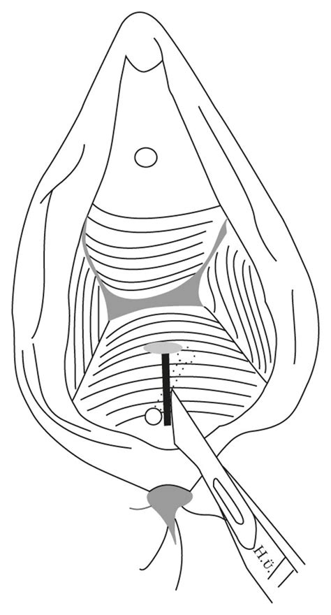 A A Curvilinear Incision Was Made Anterior To The Rectum And A Plane