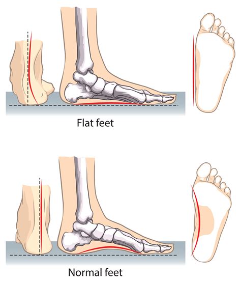Treatment For Pttd And Adult Acquired Flatfoot