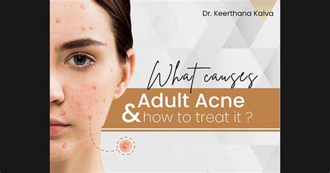 What Causes Adult Acne And How To Treat It