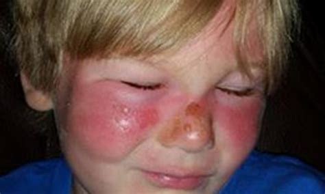 Boy Suffers Second Degree Burns After Using Banana Boat Sunscreen Kidspot