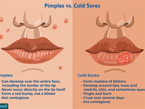 Cold Sore And Swelling Lips