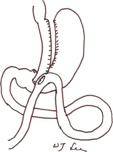 Schema Of Laparoscopic Single Anastomosis Mini Gastric Bypass A