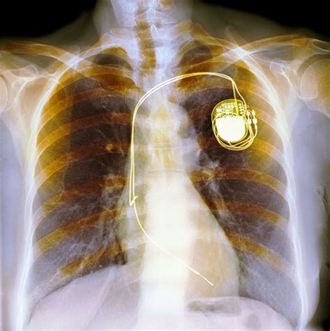 Implantierbare Kardioverter Defibrillator Komplikationen