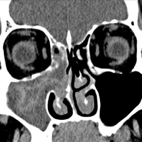 Coronal Ct Scan Right Maxillary Odontogenic Sinusitis Oroantral