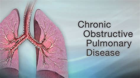 Copd Symptoms Causes And Treatments Dmicc