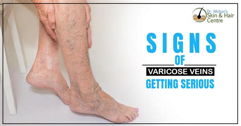 What Are The Signs Of Varicose Veins Getting Serious