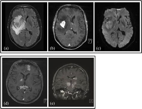 Brain Magnetic Resonance Imaging Mri Of Two Patients A C D And E Download Scientific
