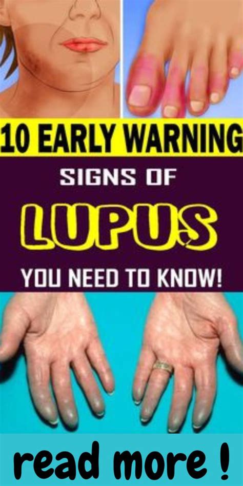 13 Early Warning Signs Of Lupus You Should Know Natural Health Care