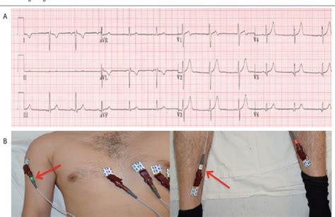 Figure 6 From Common Ecg Lead Placement Errors Part I Limb Lead