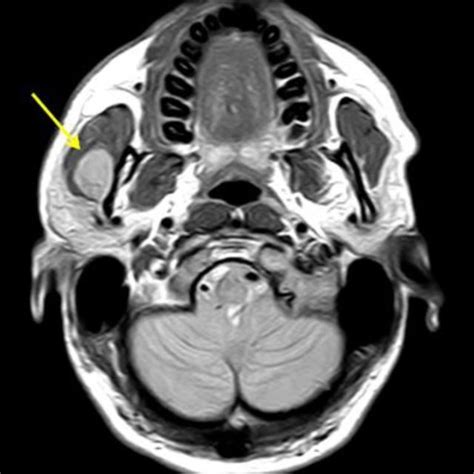 Mri Showing An Oval Mass In The Right Masseter Muscle Which Was Mildly