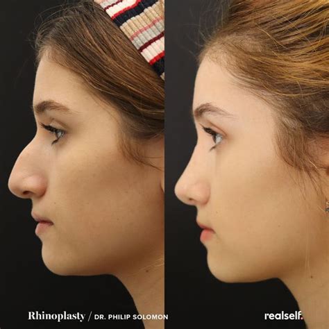 Rhinoplasty The Ultimate Guide To Nose Jobs Realself Rhinoplasty Before And After Nose Job