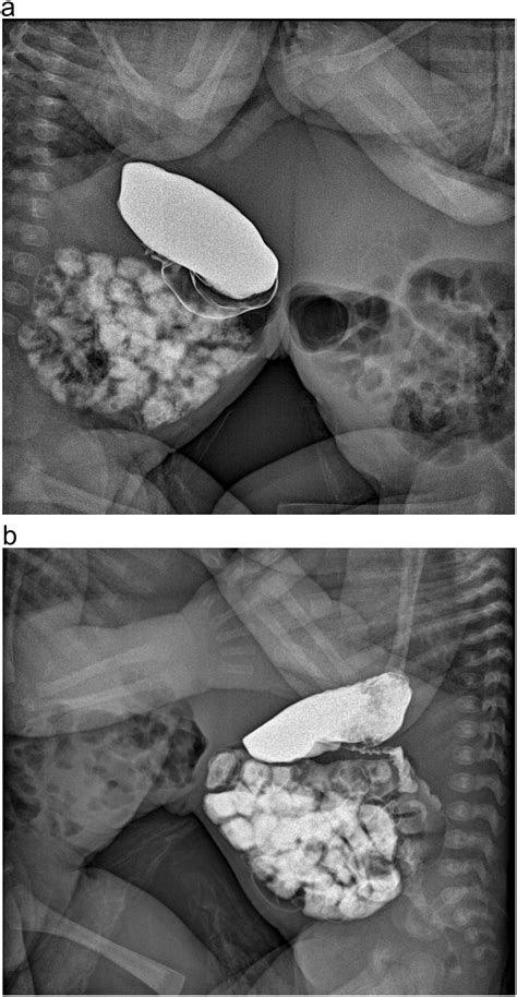 imaging of liver fusion and vascular intra hepatic shunts in omphalopagus conjoined twins the