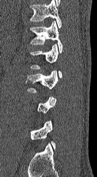 Burst Fracture Radiopaedia 53373 59357 Sagittal Bone Window Nc Commons