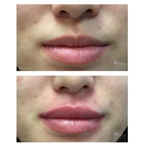 Juvederm In The Lips Before And After