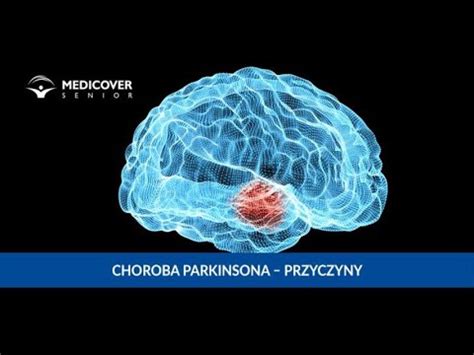 Choroba Parkinsona Przyczyny Objawy I Leczenie Parkinsona Youtube
