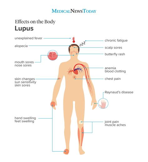 Early Signs Of Lupus How To Identify Them