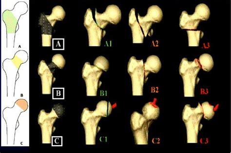 The AO Classification System Of Proximal Femur Fractures Reproduced Download Scientific